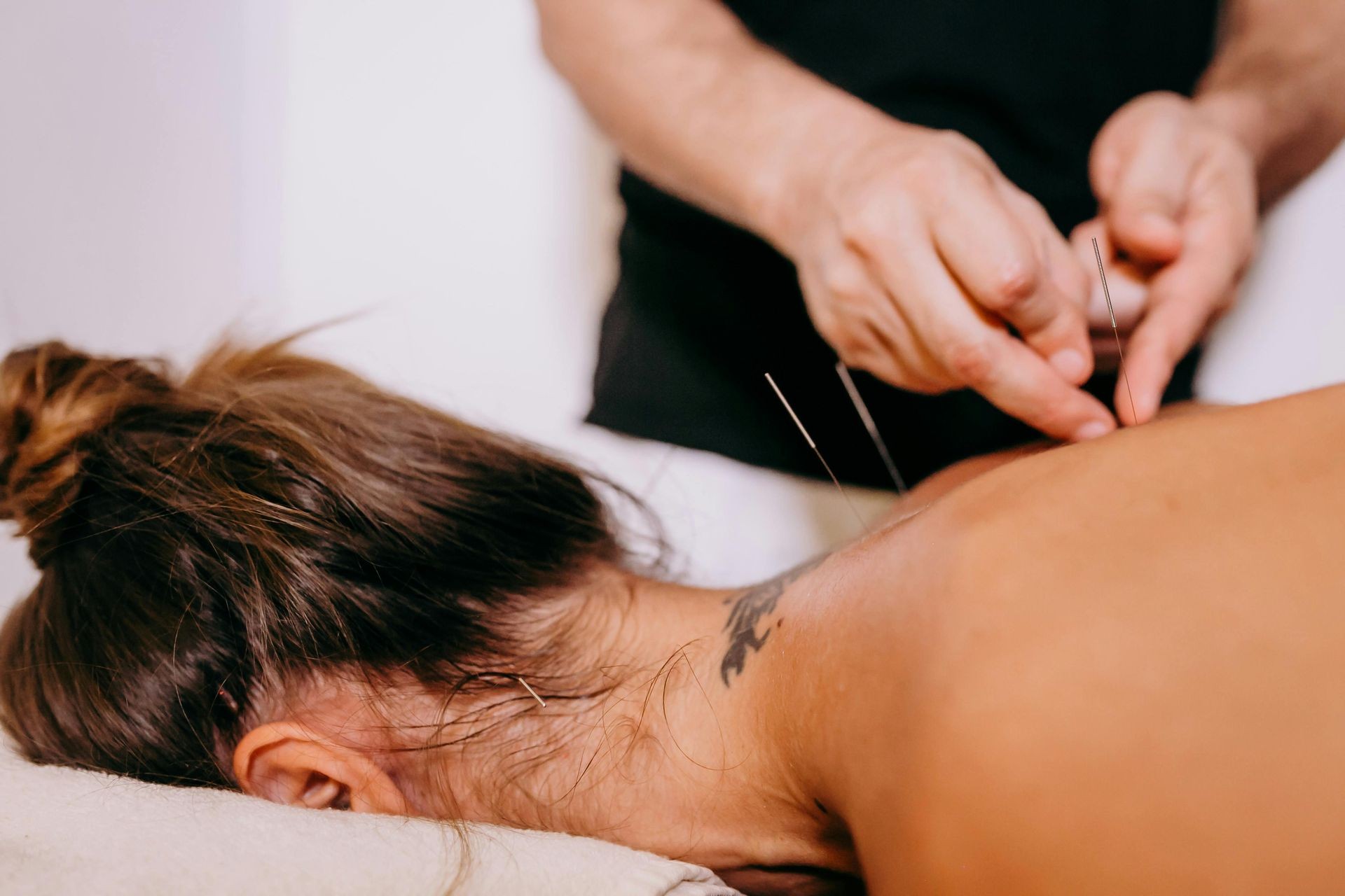 relaxed woman receiving acupuncture treatment