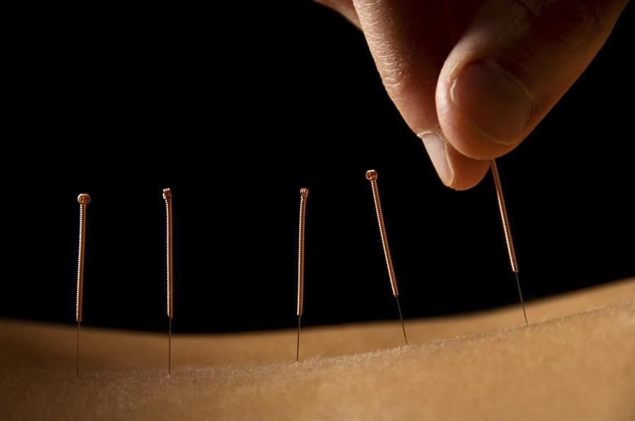 ACUPUNCTURE needles on the body